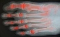 Easing Foot Pain From Rheumatoid Arthritis