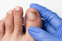 Ways to Deal With Toenail Fungus