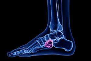 Cuboid Syndrome in Athletes